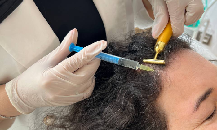 قطع ریزش مو با مزوتراپی